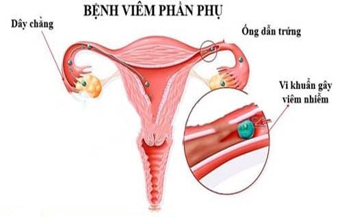 viêm phần phụ