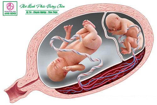 Hội chứng thai đôi truyền máu cho nhau
