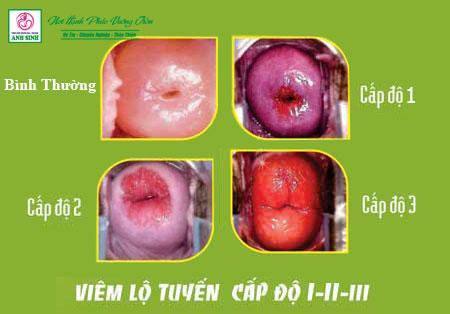 Điều trị viêm lộ tuyến cổ tử cung tại Nghệ An