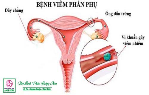 Điều trị Viêm phần phụ tại Nghệ An