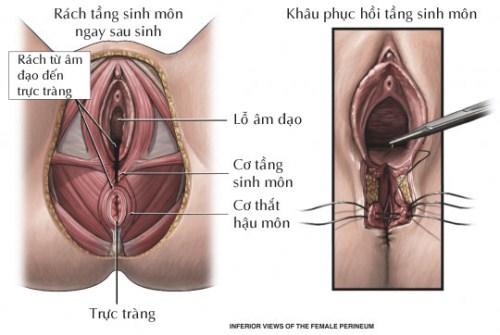 Thẩm mỹ tầng sinh môn tại Nghệ An