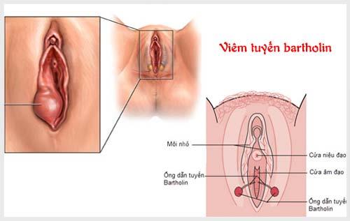 Nang tuyến Baetholin tại Nghệ An