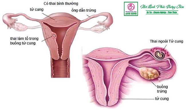 Thai ngoài tử cung