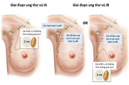 Siêu âm vú tại Nghệ An