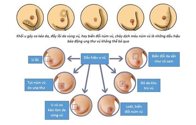 Siêu âm vú tại Nghệ An