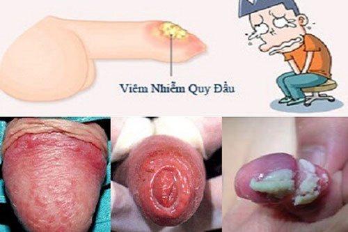 Bệnh nam khoa và địa chỉ khám bệnh uy tín tại Nghệ An