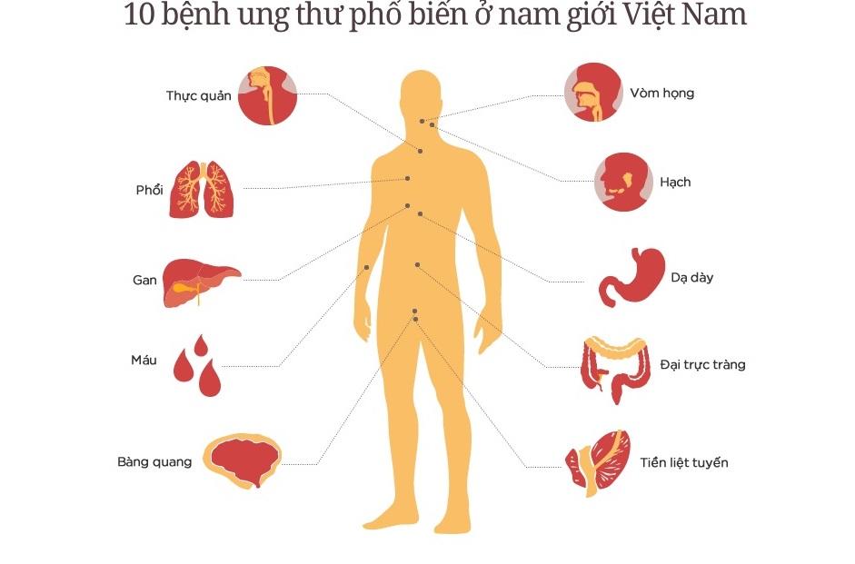 Tầm soát ung thư ở Nghệ An