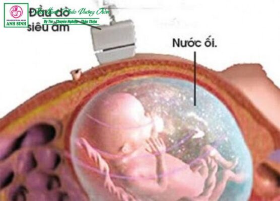 Đa ối khi mang thai