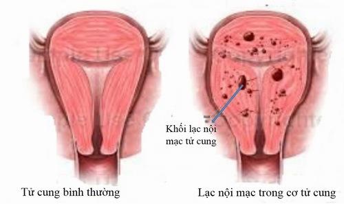 điều trị lạc nội mạc tử cung