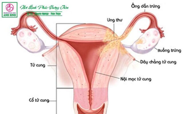 tầm soát ung thu cổ tử cung tại Vinh