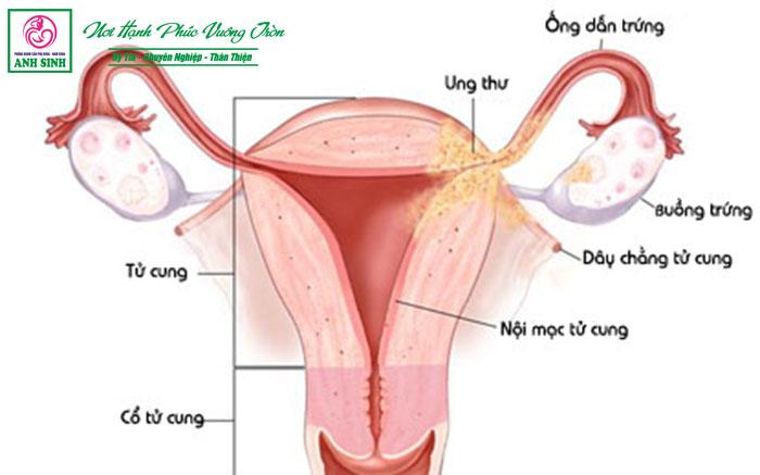 ung thu cổ tử cung