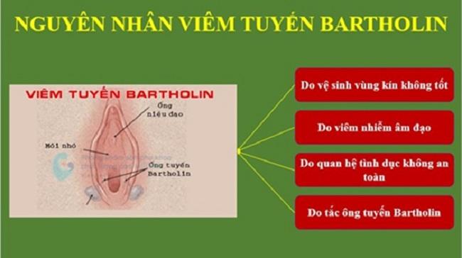 Viem-tuyen-Bartholin