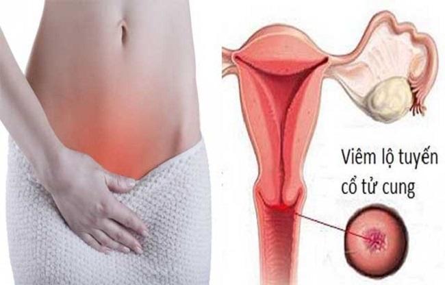 viêm lộ tuyến cổ tử cung 