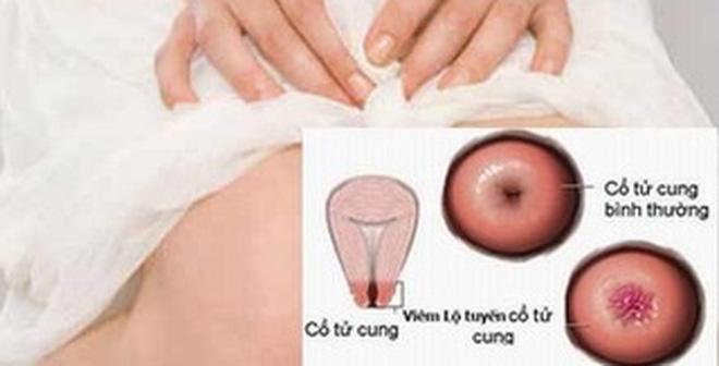 Tìm hiểu về bệnh viêm lộ tuyến cổ tử cung 