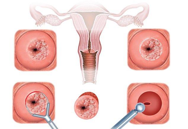 Tìm hiểu về bệnh viêm lộ tuyến cổ tử cung 