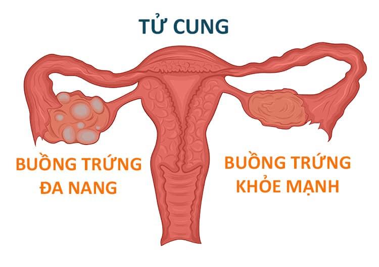 Những dấu hiệu nhận biết bệnh buồng trứng đa năng 