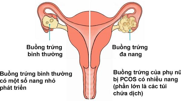 Những dấu hiệu nhận biết bệnh buồng trứng đa năng