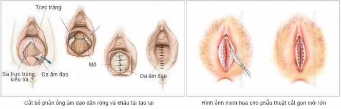 Thẩm mỹ tầng sinh môn ở đâu tốt nhất