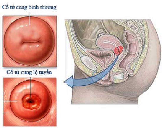 viêm lộ tuyến khi mang thai