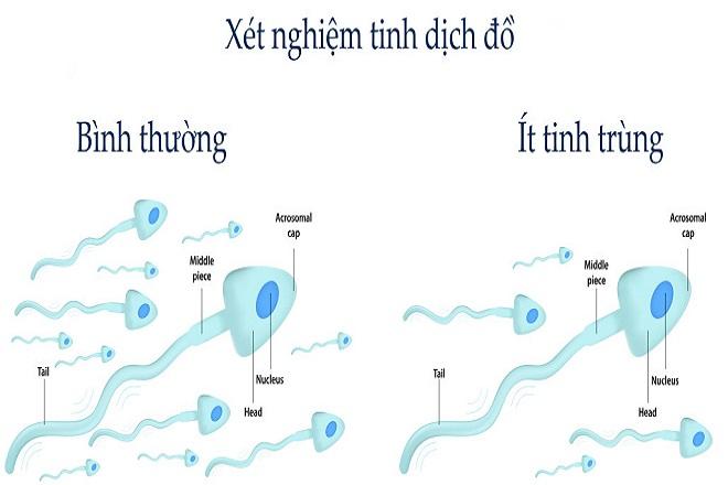 điều trị vô sinh nam tại Vinh