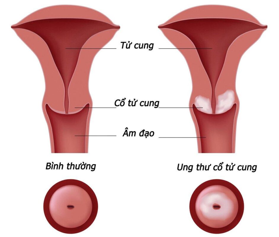 Tầm soát ung thư cổ tử cung tại Vinh