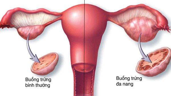 điều trị vô sinh nữ tại Vinh