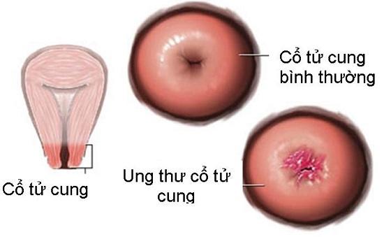 tầm soát ung thư cổ tử cung tại Vinh