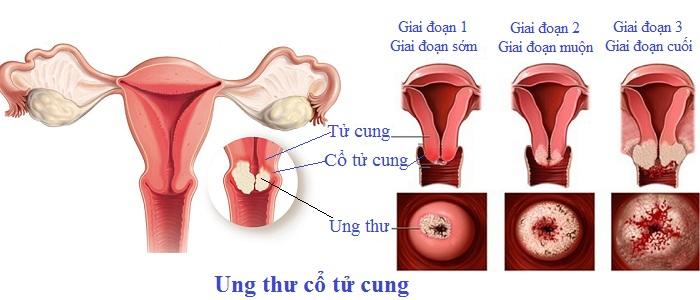 tầm soát ung thư cổ tử cung tại Vinh