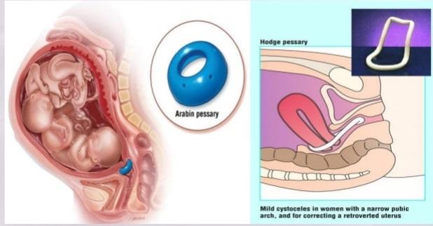 Vòng nâng Pessary - Phòng khám Anh Sinh
