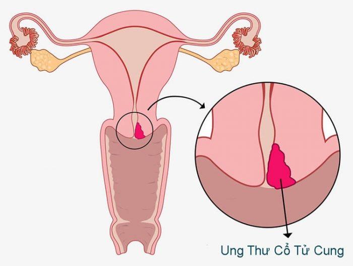 Tầm soát ung thư cổ tử cung tại Vinh