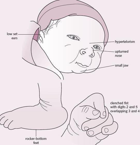 sàng lọc trước sinh không xâm lấn NIPT