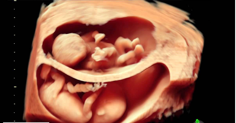 Mẹ bầu cần biết gì về siêu âm doppler thai nhi